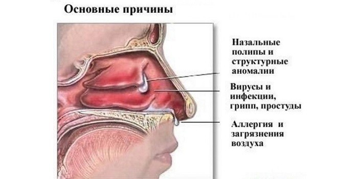 Хронічний сфеноидит – що це таке? Сфеноидит: симптоми, діагностика та лікування