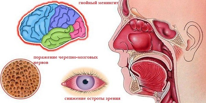 Хронічний сфеноидит – що це таке? Сфеноидит: симптоми, діагностика та лікування