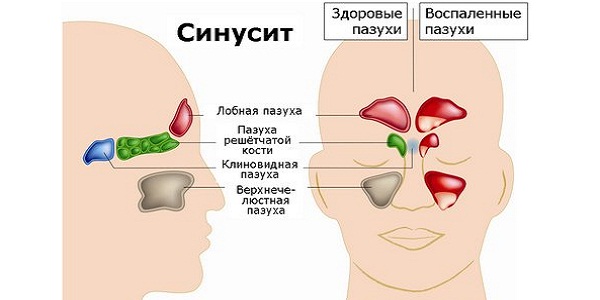 Хронічний синусит у дорослих як і чим лікувати