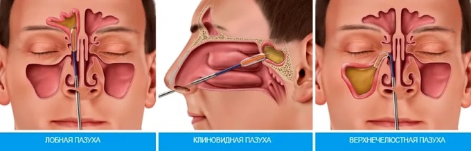 Хронічний синусит його види форми і способи лікування