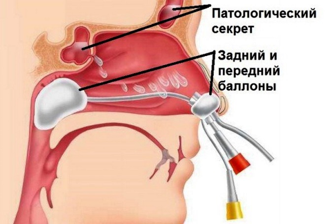 Хронічний синусит його види форми і способи лікування