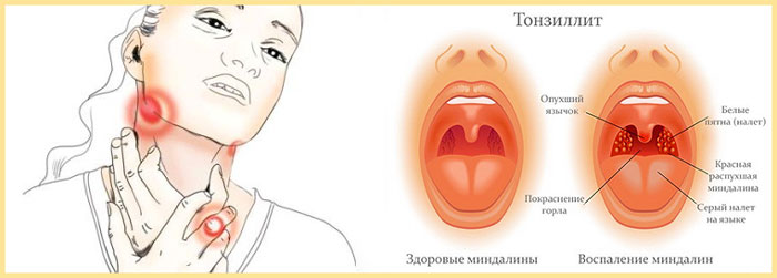 Хронічний тонзиліт – Хвороби оториноларингології