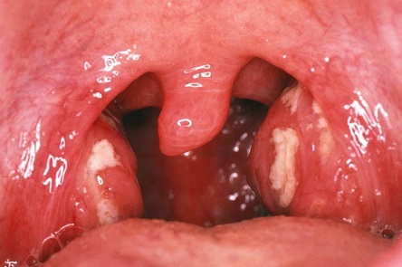 Хронічний тонзиліт: симптоми і лікування у дорослих