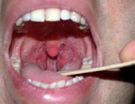 Хронічний тонзиліт: симптоми і лікування у дорослих