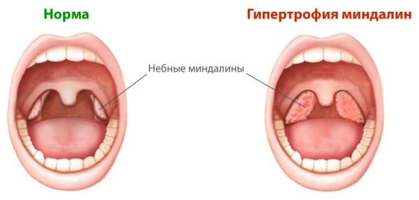 Хронічний тонзиліт у дорослих причини і методи лікування