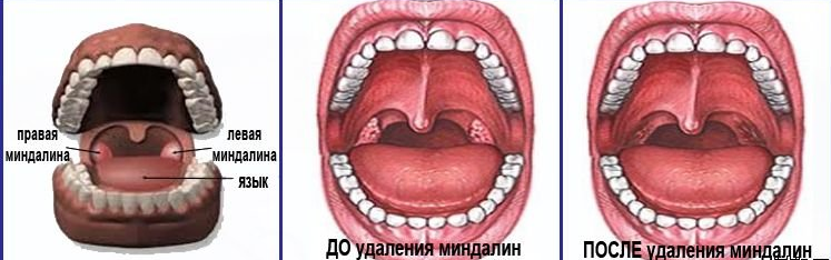 Хронічний тонзиліт у дорослих причини і методи лікування