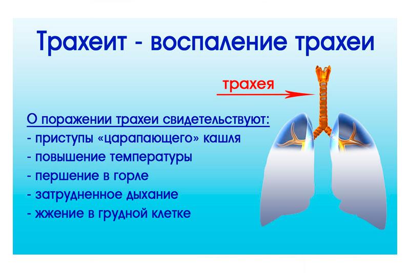 Хронічний трахеїт – причини, симптоми,лікування