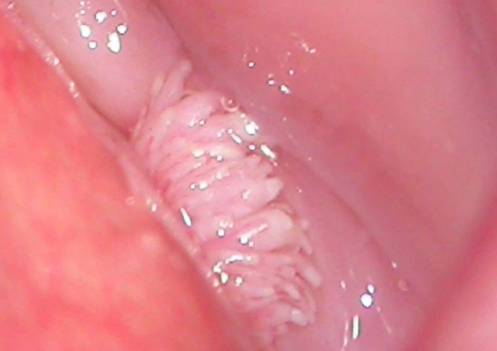 Хто лікував папілому в піхву народними засобами Хто лікував папілому в піхву народними засобами