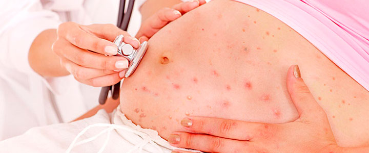 Хворіють на вітрянку дорослі?