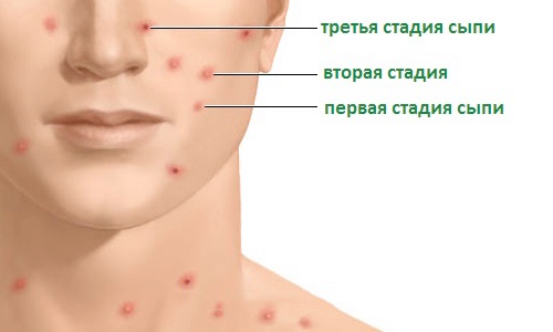 Хворіють на вітрянку дорослі?