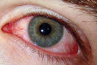 Хворе горло без почервоніння