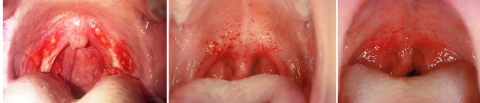 Хворе горло без почервоніння