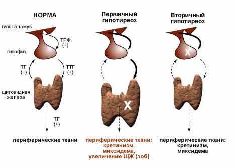 Хвороба гіпотиреоз симптоми і методи лікування
