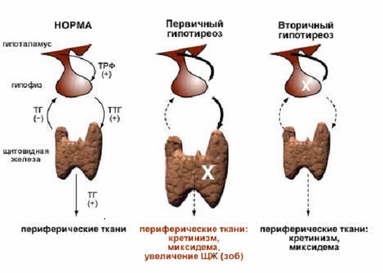 Хвороба гіпотиреоз симптоми і методи лікування Хвороба гіпотиреоз симптоми і методи лікування