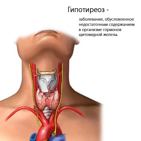 Хвороба гіпотиреоз симптоми і методи лікування