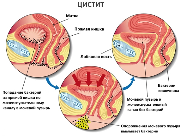 Хвороби сечового міхура у чоловіків та їх симптоми