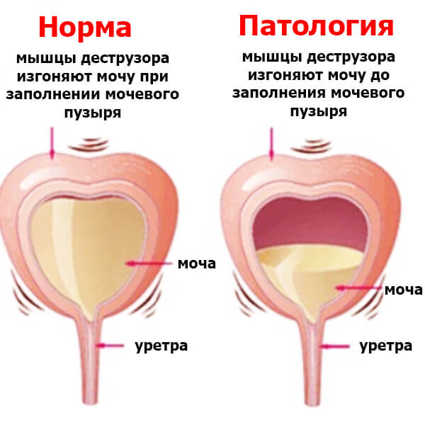 Хвороби сечового міхура у чоловіків та їх симптоми