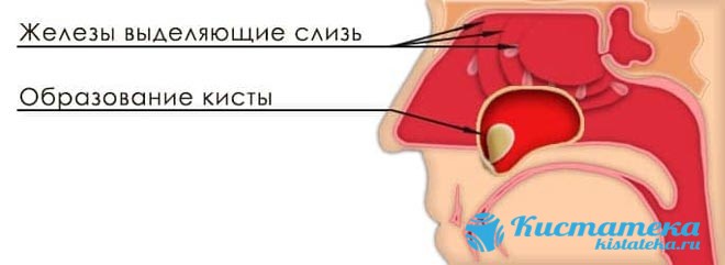 Кіста гайморової пазухи: до чого може призвести, симптоми і лікування, фото