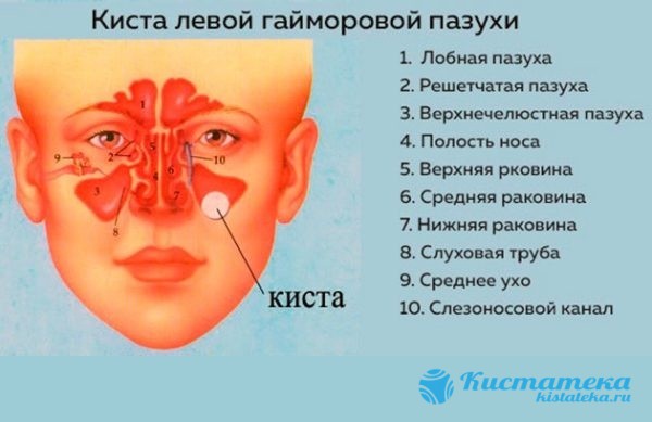 Кіста гайморової пазухи: до чого може призвести, симптоми і лікування, фото