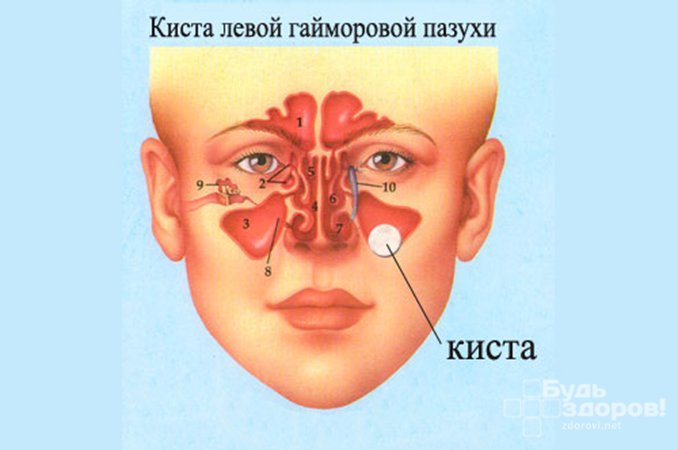 Кіста гайморової пазухи – симптоми, лікування, видалення