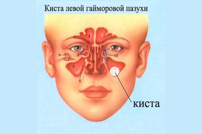 Кіста гайморової пазухи – симптоми, лікування, видалення