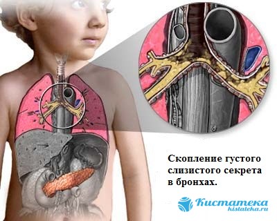 Кіста гайморової пазухи – симптоми, лікування, видалення