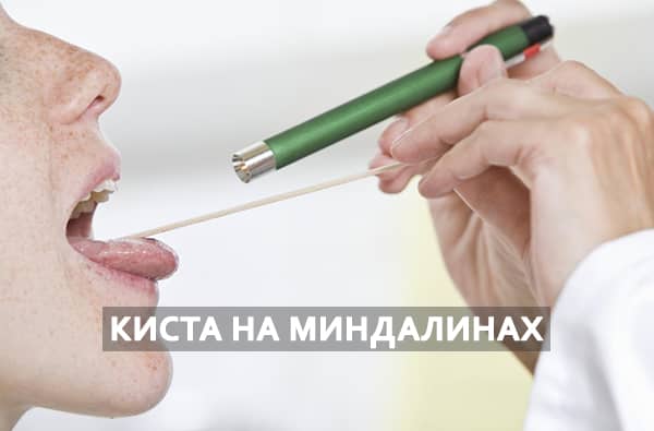 Кіста мигдалини симптоми лікування