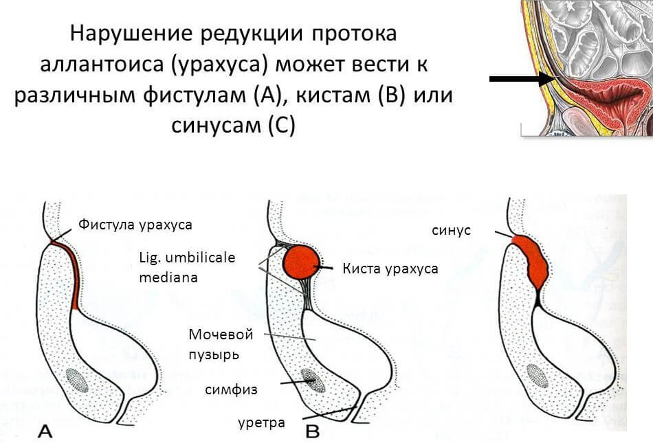 Кіста сечового міхура або як е називають медики кіста урахуса