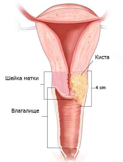 Кіста шийки матки причини виникнення, діагностика та лікування