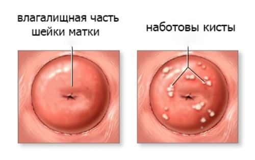 Кіста шийки матки причини виникнення, діагностика та лікування