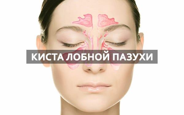 Кіста в лобовій пазусі