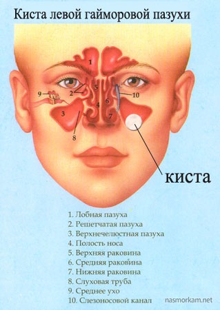 Кіста в носі – лікування народними засобами без операції, що робити?