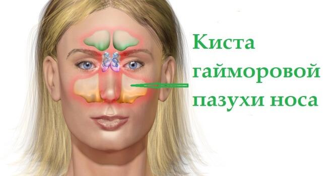 Кістозний гайморит симптоми і лікування
