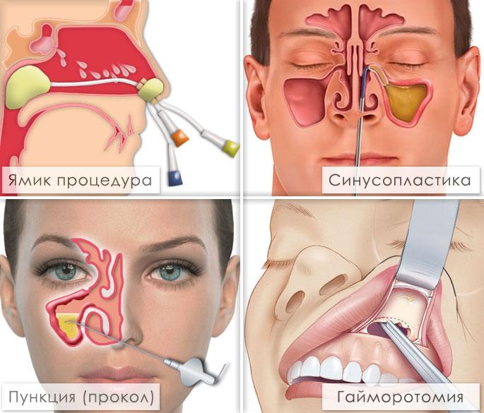 Кістозний гайморит симптоми і лікування