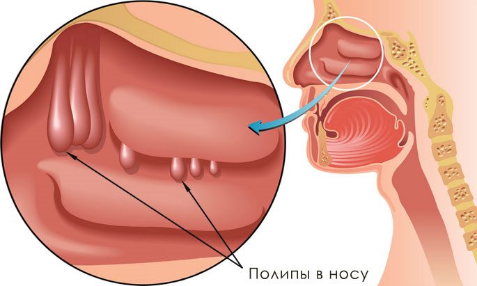 Кістозно-поліпозний гайморит хто – Хвороби носа