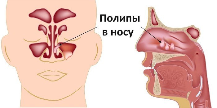 Кістозно-поліпозний гайморит хто – Хвороби носа