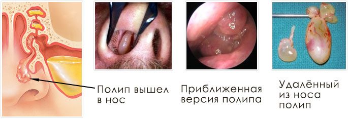 Кістозно-поліпозний гайморит хто – Хвороби носа