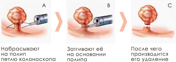 Кістозно-поліпозний гайморит хто – Хвороби носа