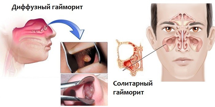 Кістозно-поліпозний гайморит хто – Хвороби носа