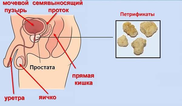 Камені в простаті лікування народними засобами