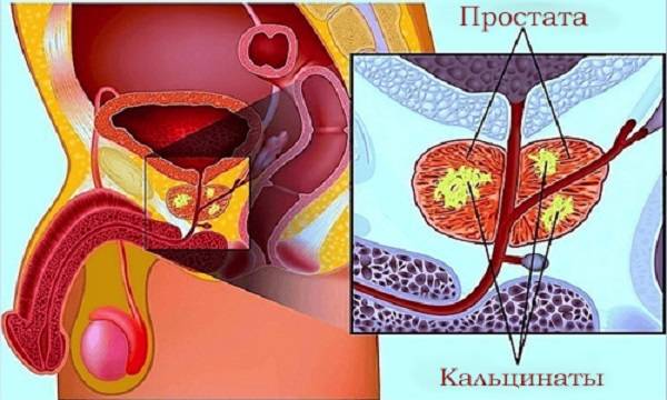 Камені в простаті лікування народними засобами