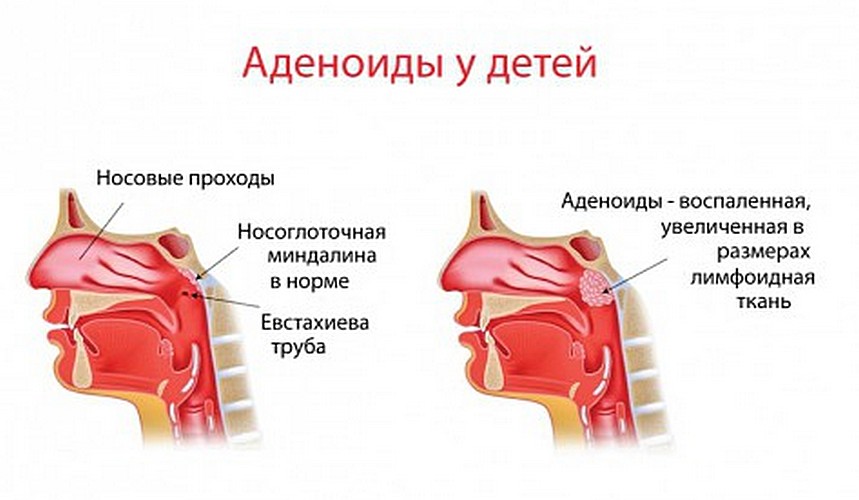 Кашель при аденоїдах у дітей: ефективне лікування