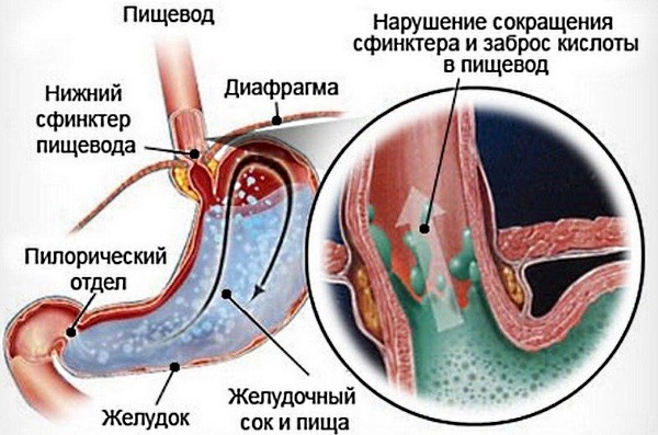 Клубок у горлі. Причини і лікування слизу в горлі, біль у грудній клітці, відрижка. Як позбутися після їжі, народні засоби