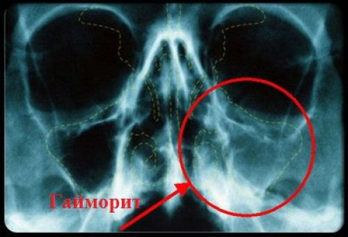 Коли призначається рентгенографія придаткових пазух носа і про що вона може “розповісти”