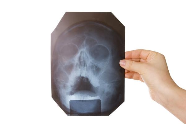 Коли призначається рентгенографія придаткових пазух носа і про що вона може “розповісти”