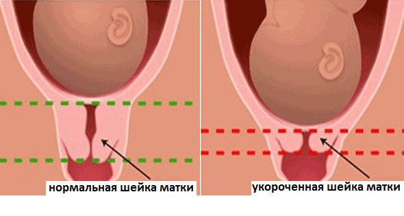 Конізація шийки матки підготовка методи проведення післяопераційний період
