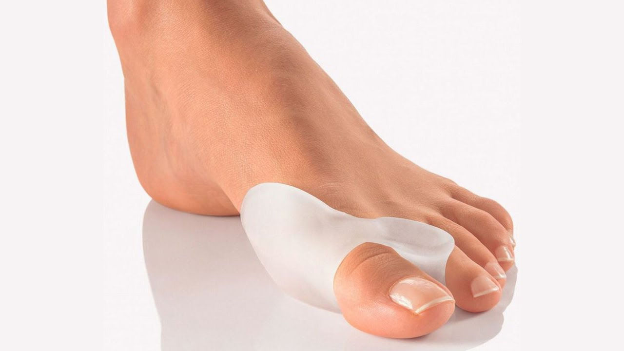Консервативне лікування кісточки на великому пальці ноги