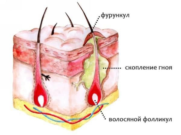 Корисні поради Чим вилікувати болячки в носі