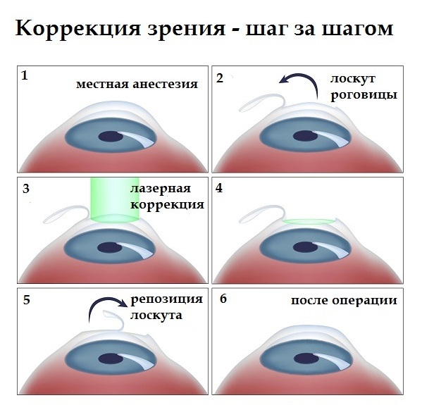 Короткозорість ступеня лікування корекція міопії вправи для очей