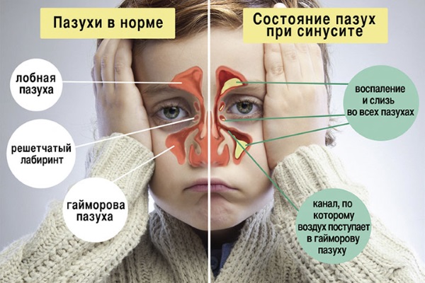 Краплі для носа при нежиті: які краще? Найбільш безпечні та ефективні